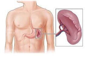 патология на далака като причина за болка под лявата лопатка