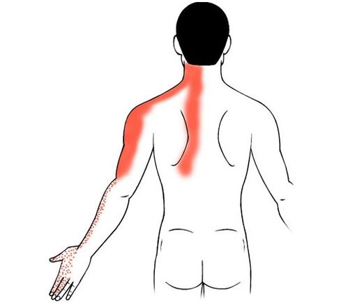цервикална остеохондроза като причина за болка в ставите на пръстите